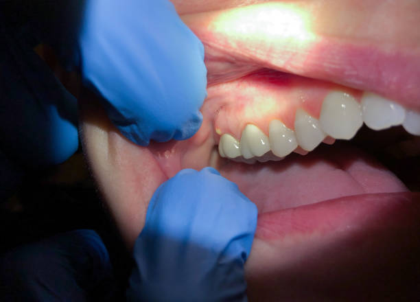 Best Cracked Tooth Emergency Dentist  in St Francisville, LA